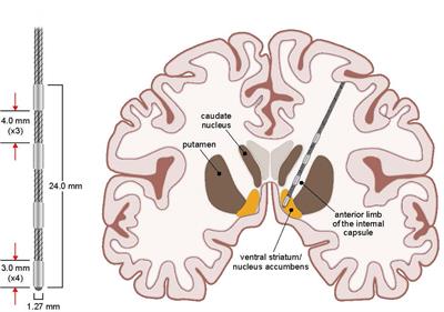 Deep Brain Stimulation for Obsessive–Compulsive Disorder: A Long Term Naturalistic Follow Up Study in a Single Institution